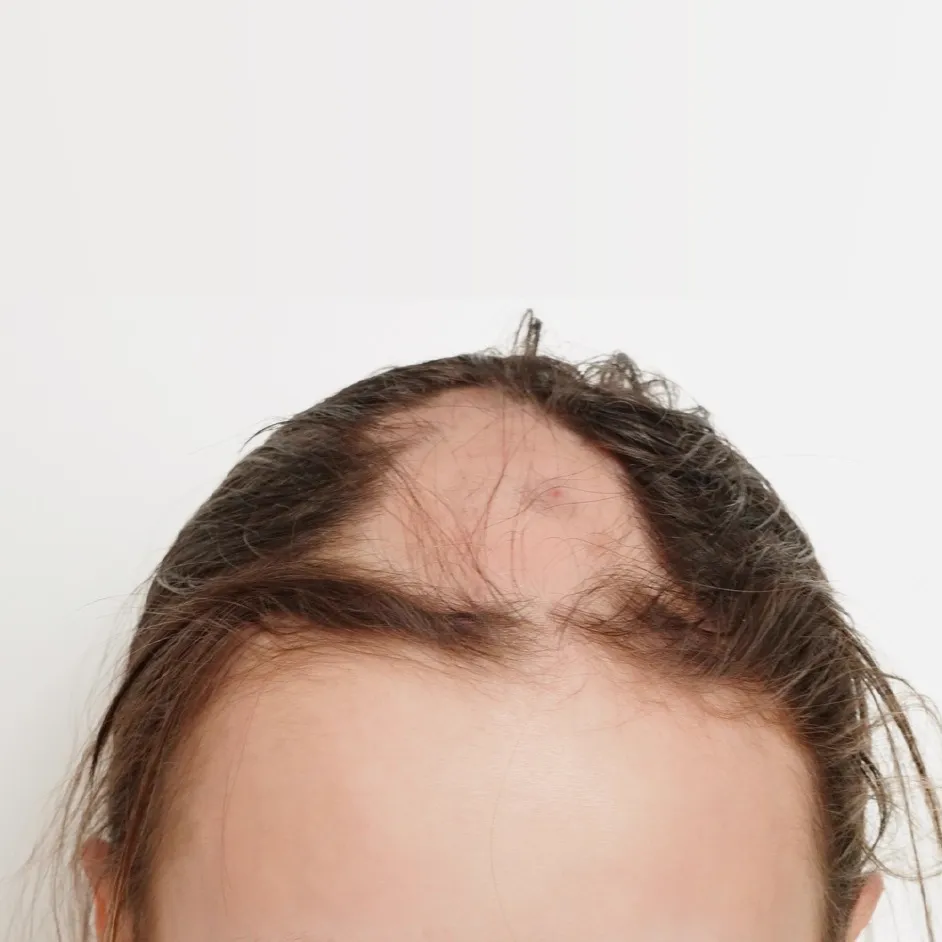 Alopecia Areata Regrowth Before After - 6 Months Steroid Injection Treatment Ranchi