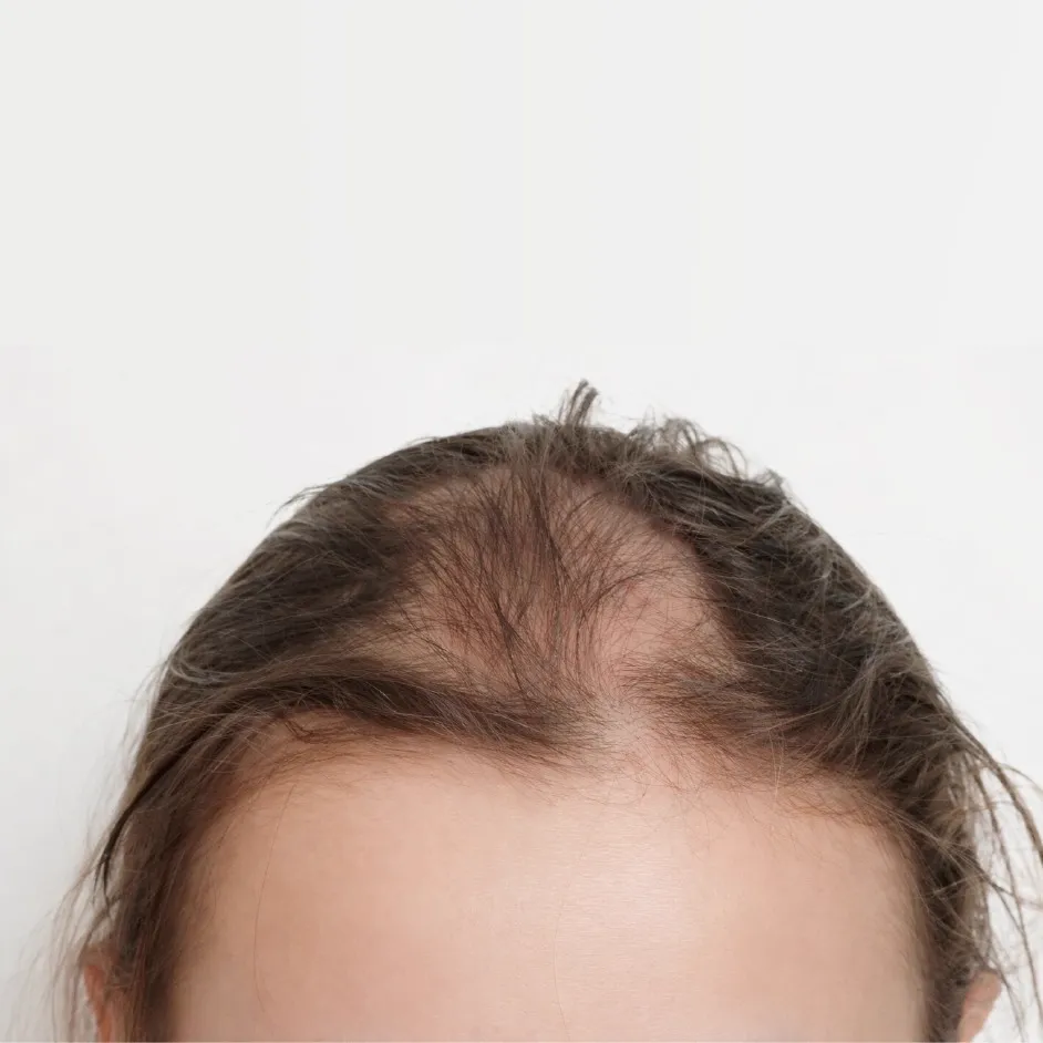 Pattern Baldness Improvement Before After - 8 Months PRP and Minoxidil Treatment