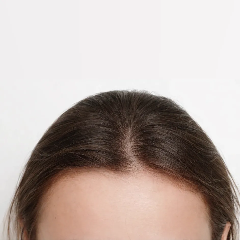 Female Hair Loss Recovery Before After - 5 Months Combination Therapy