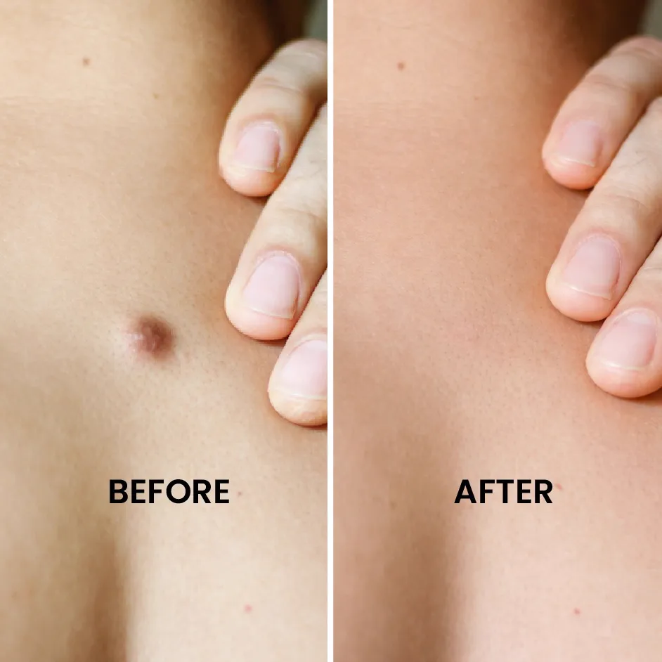 Wart Mole Cyst Removal Before After Results at Shanti Skin and Laser Center Ranchi