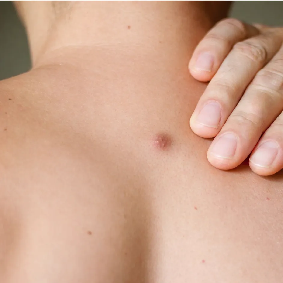 Raised Mole Surgical Excision Before After Results