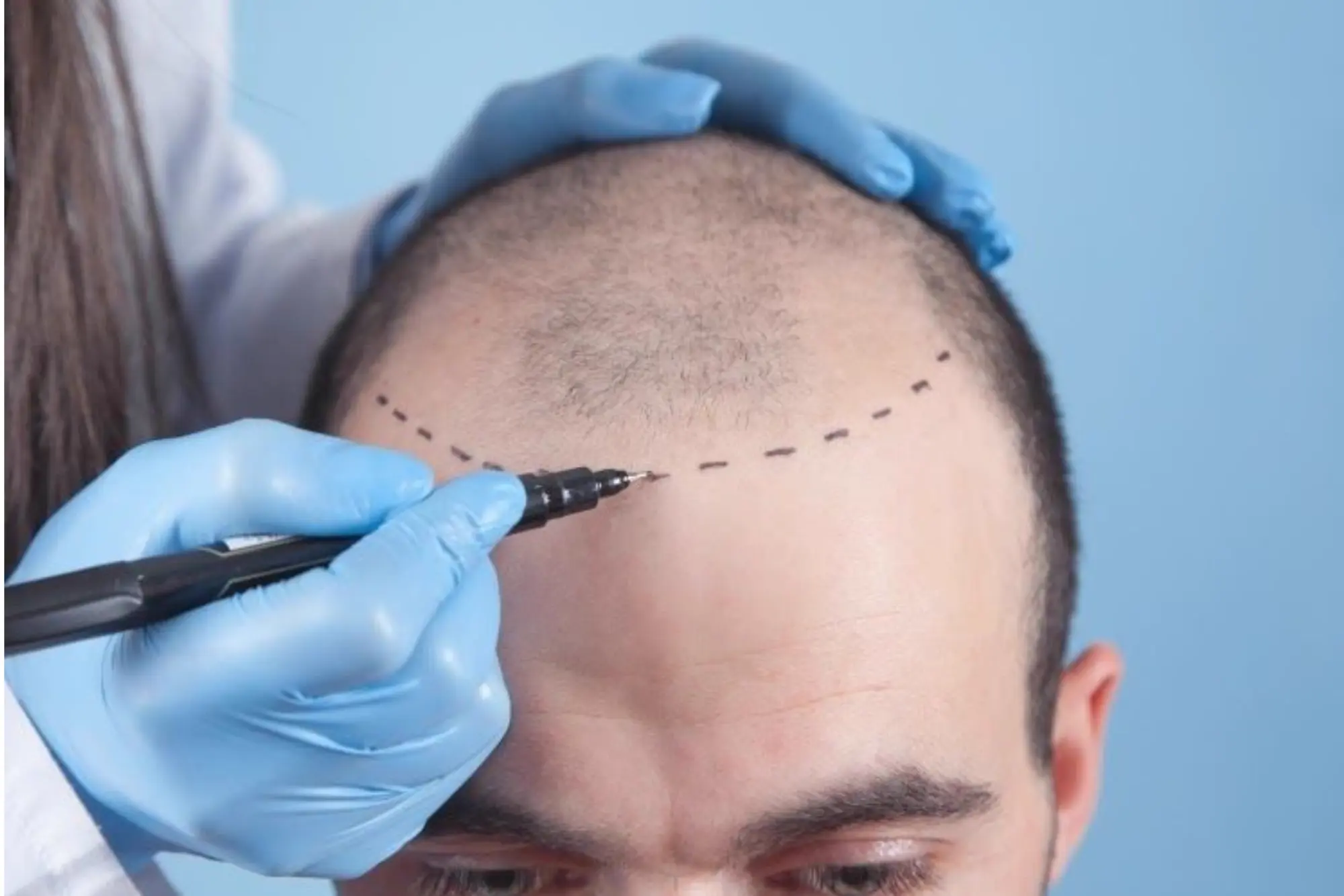 Hair Restoration