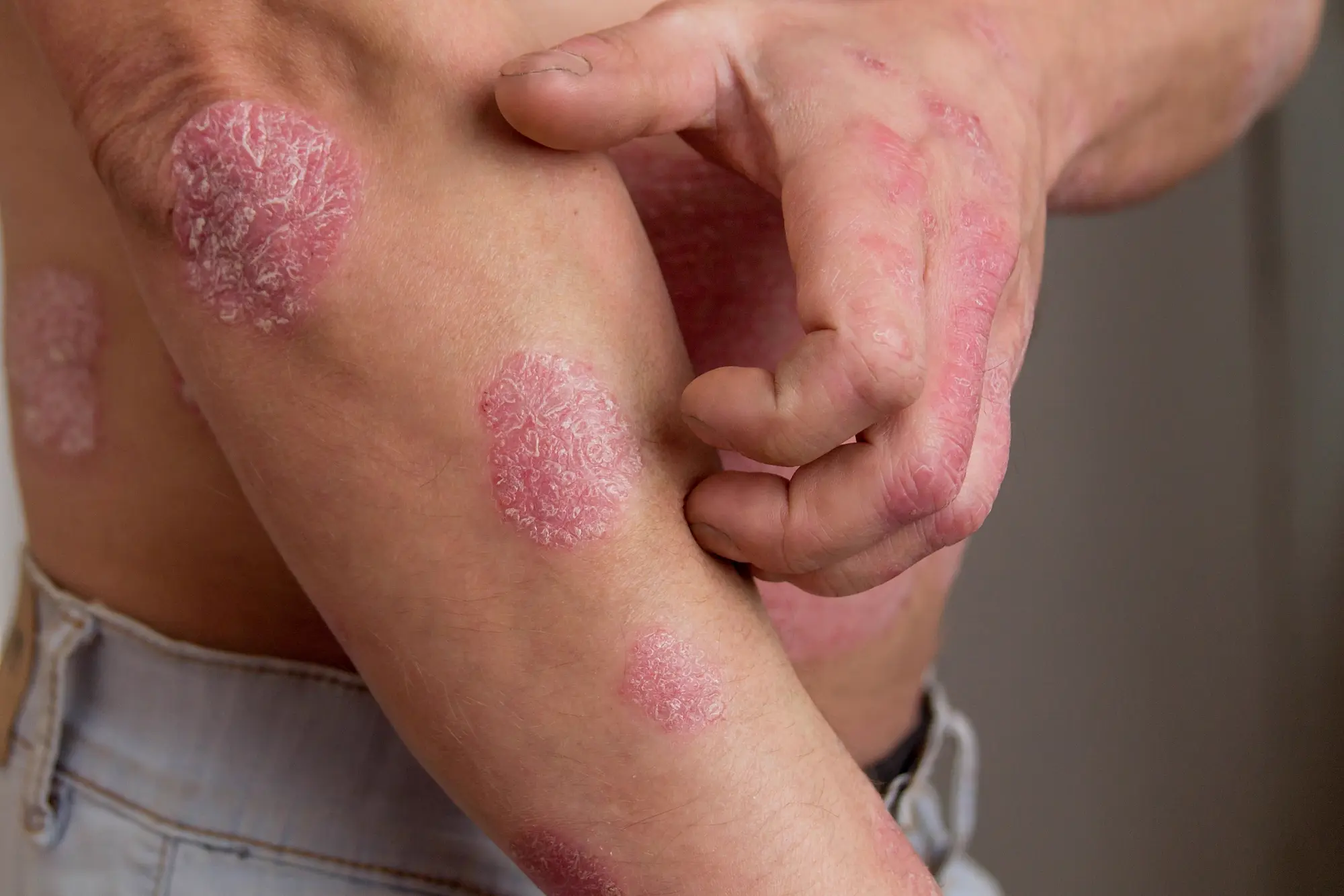 Psoriasis