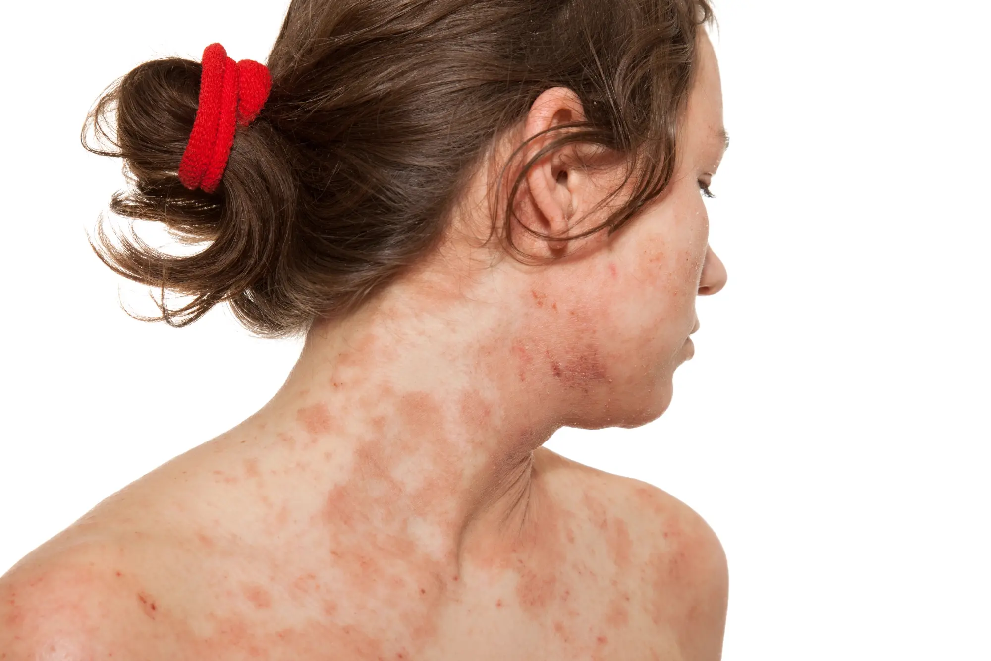 Skin Allergies
