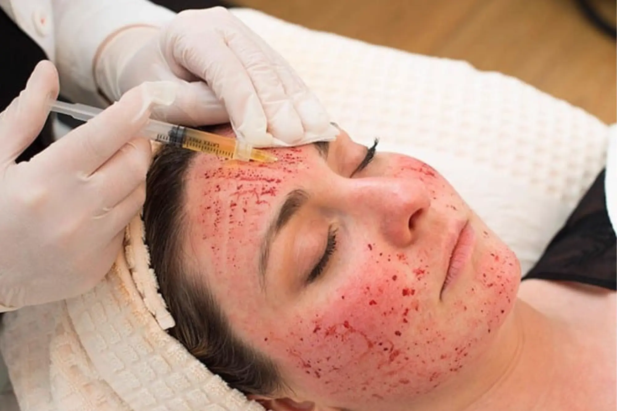 Vampire Face Lift