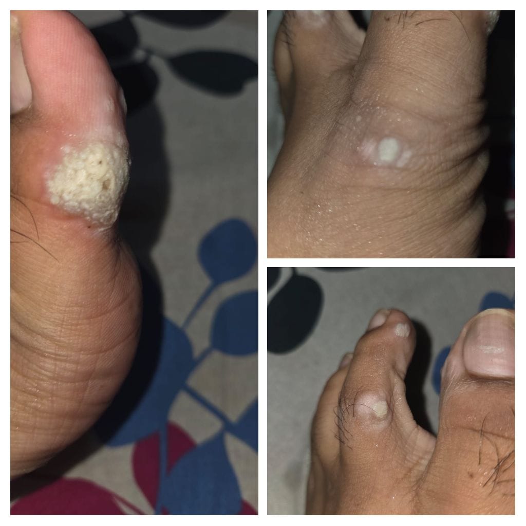 Finger Wart