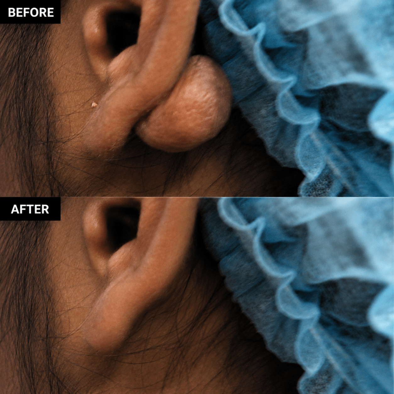 Keloid - Earlobe