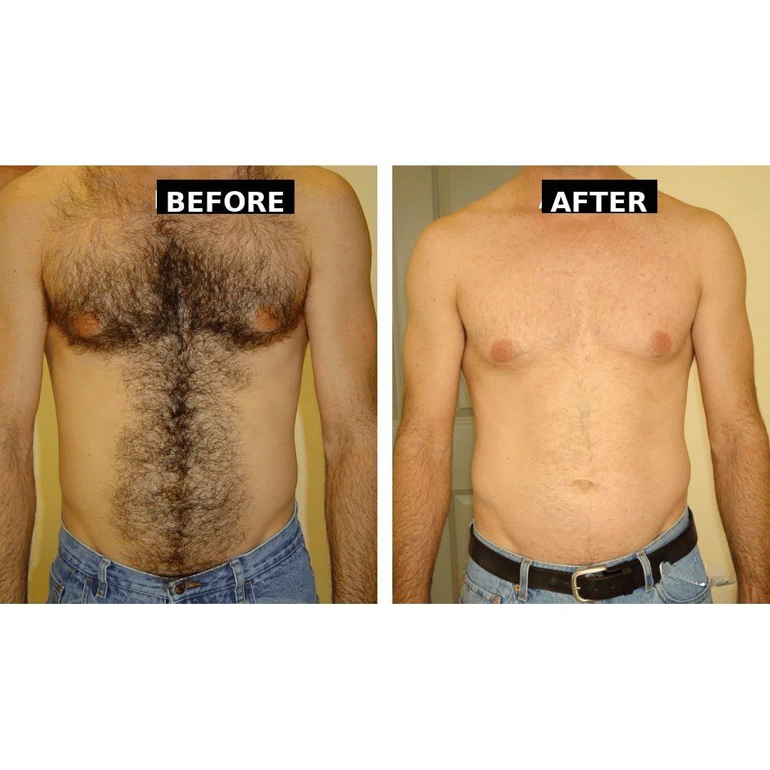 LHR - Chest