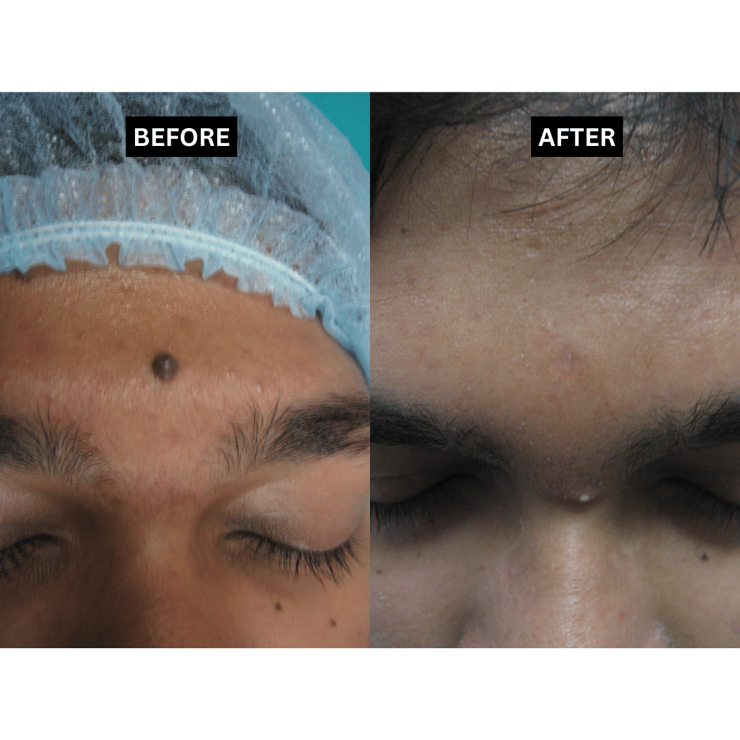 Mole -  Forehead