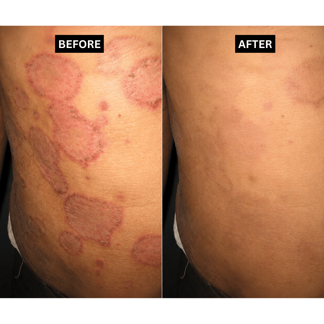Psoriasis