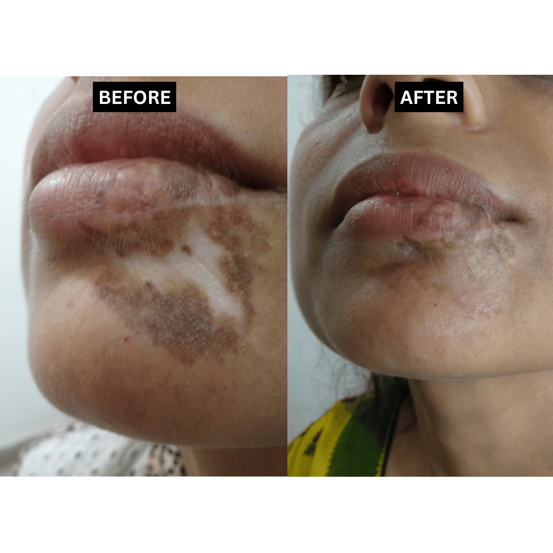 Vitiligo