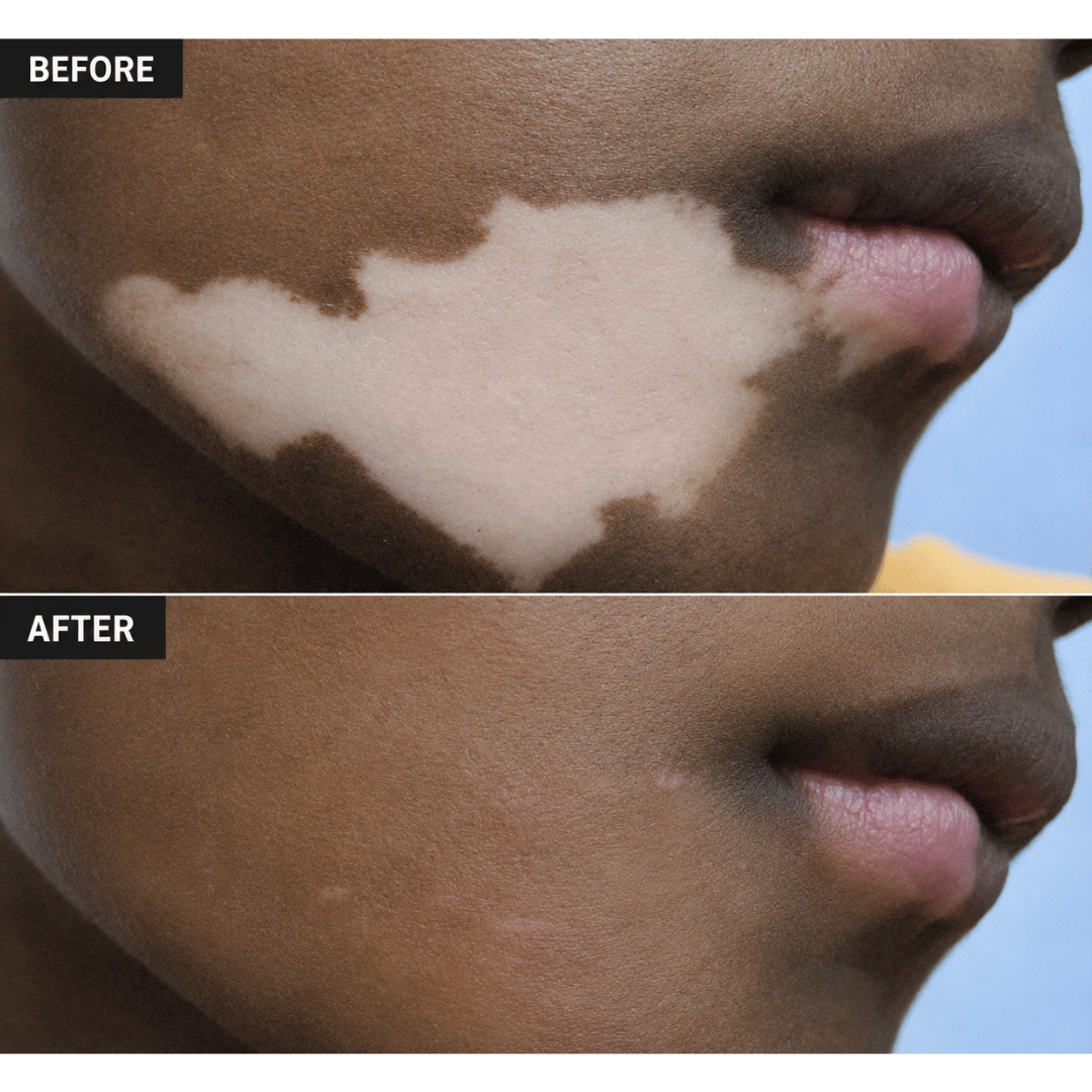 Vitiligo