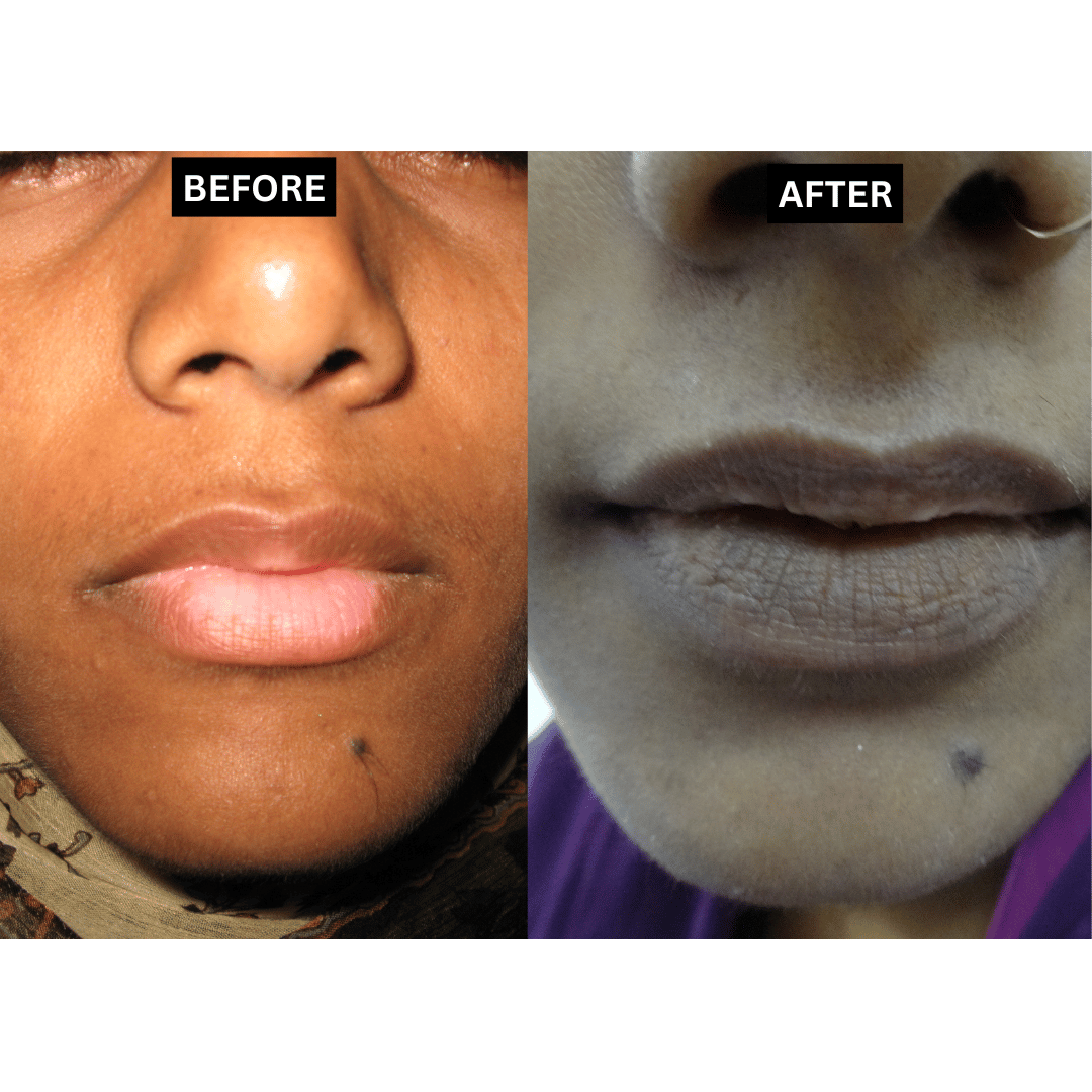 Vitiligo