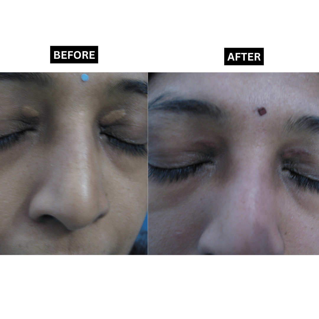 Xanthelasma