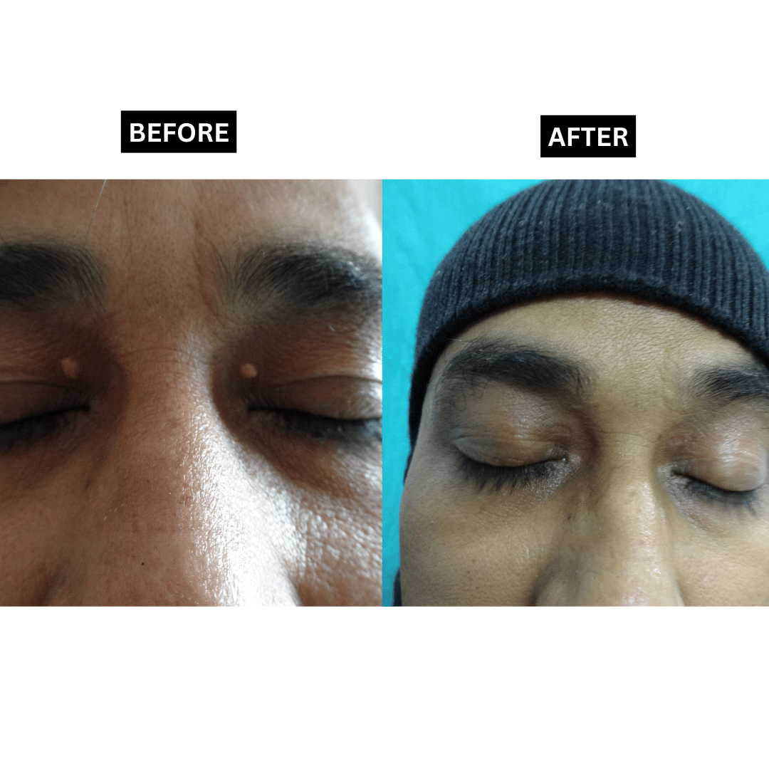 Xanthelasma