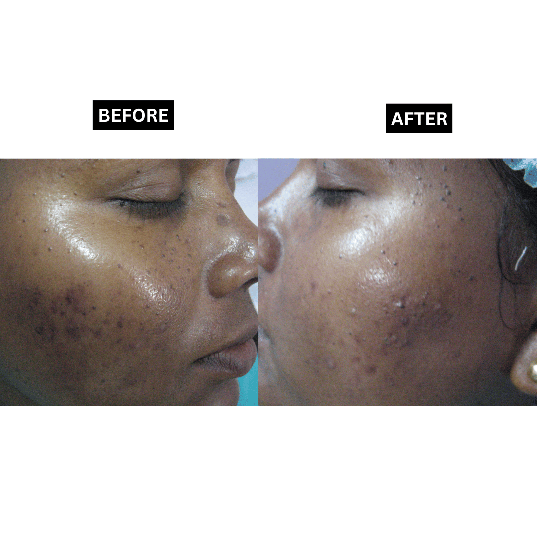 Seborrheic Keratosis