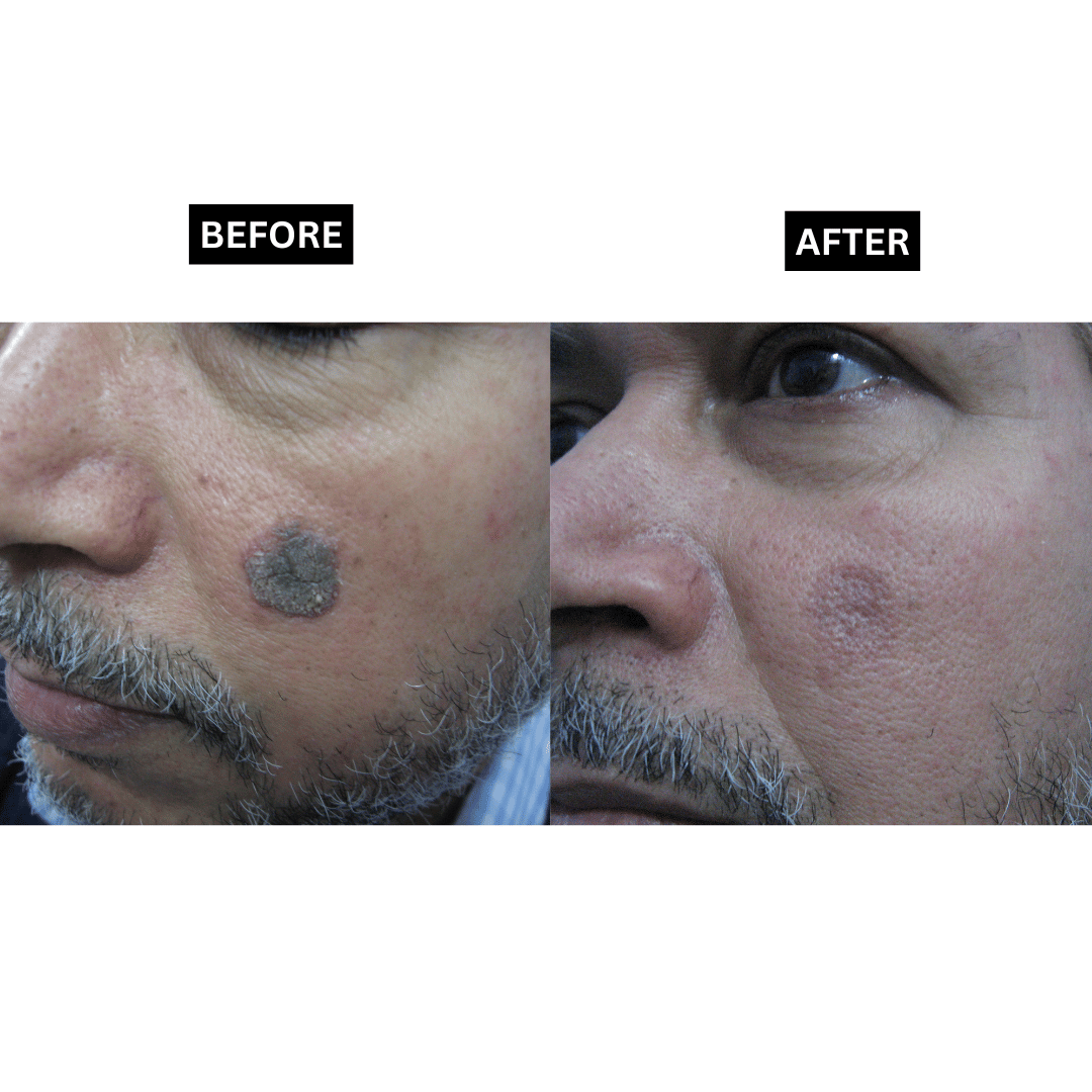 Seborrheic Keratosis