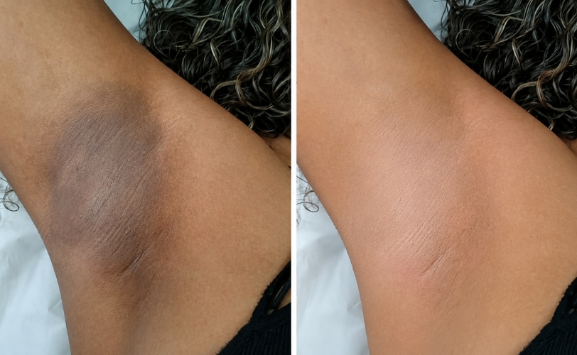 Underarm Peel